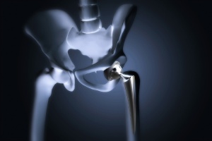 Hip replacement surgery at a leading hospital in Kadapa, providing advanced orthopedic care