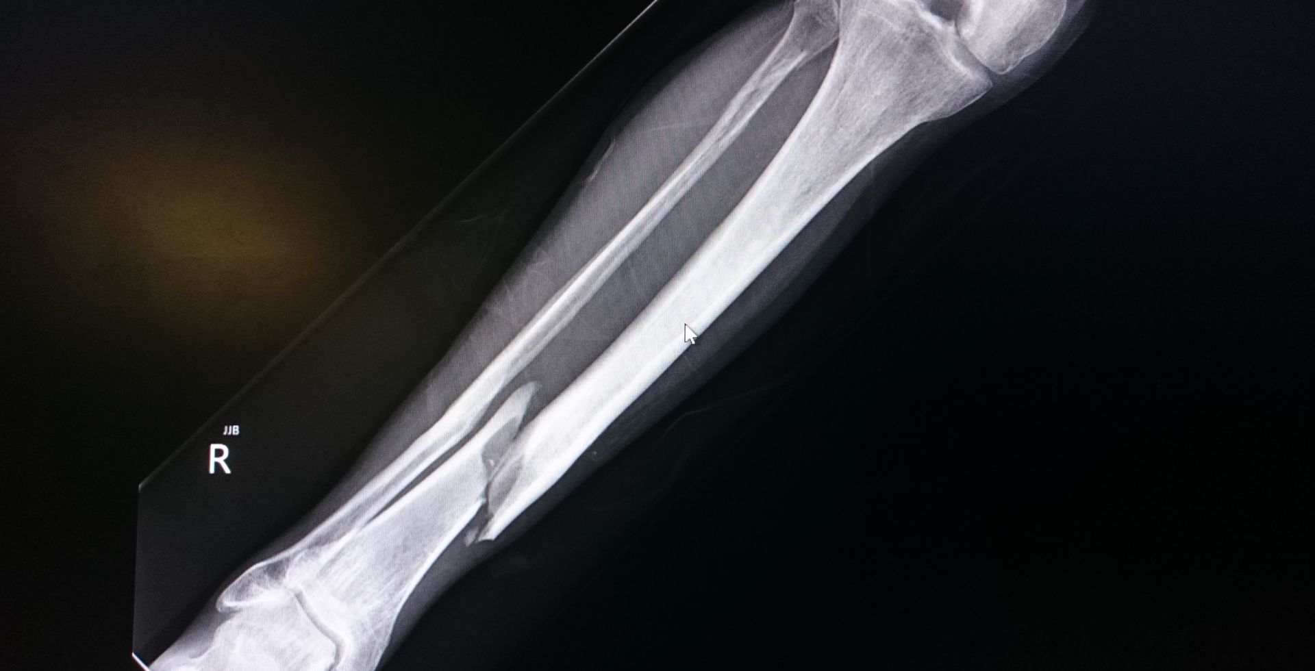 fracture-surgeries-treatment-kadapa-sri-bindu-hospital.jpg