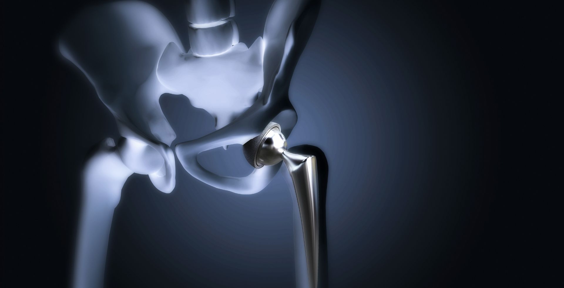 Hip Replacement Surgery at Sri Bindu Hospital Kadapa